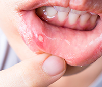 What is Mouth Ulcers Ayurvedic treatment